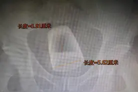 听着都疼！四川泸州一男子将啤酒玻璃杯塞进肛门，医生开腹取出图片