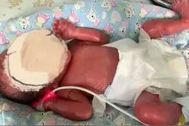 新妈妈诞下“火棉胶婴儿”，宝宝全身“油光光”像裹了一层羊皮纸，刚出生就被送进NICU图片