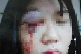 女子被丈夫殴打眼球破裂 男方已被拘留图片