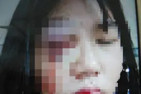 资兴妇联回应“女子被丈夫殴打眼球破裂”：已指导其收集材料图片