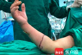 定安一男子被割草机断臂 医生紧急手术再植保肢成功图片