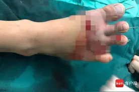 屯昌17岁小伙被升降机绞断4个足趾 医生手术再植成功图片