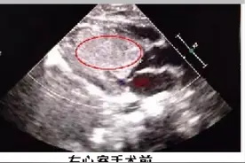 怀孕时查出胎儿先天缺陷，到底是留还是“流”？这些曾经让家长绝望的先天疾病其实都能治图片