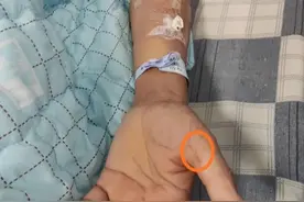 吓人！一女子在处理猪肉时被骨头刺破手，患罕见疾病！全国仅见200多例图片