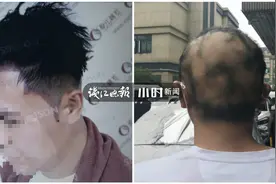 挺“秃”然的……帅小伙花一万多植发，一年后头发没了，工作丢了，女朋友也分手了图片