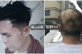 挺“秃”然的……帅小伙花一万多植发，一年后头发没了，工作丢了，女朋友也分手了图片