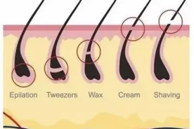 反复脱毛除不尽怎么办？激光脱毛可靠吗？听听中山七院专家怎么说图片