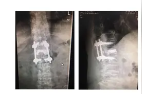 七旬老人腰痛数日后无法站立，多少老人被这种“静悄悄的疾病”击倒？图片