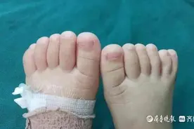 “六指宝宝”急坏家人，日照市人民医院妙手复原图片