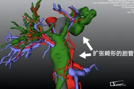肝里涌出一股“泥石流”，“雕肝大师”出手救了六旬阿婆图片