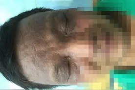 电焊工人顶了三个月的「熊猫眼」，究竟是什么病？图片
