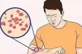 毛毛虫刺伤、马蜂蜇伤、蜈蚣咬伤、蜱虫钻进肉里……惹到“虫虫特工队”怎么办？图片