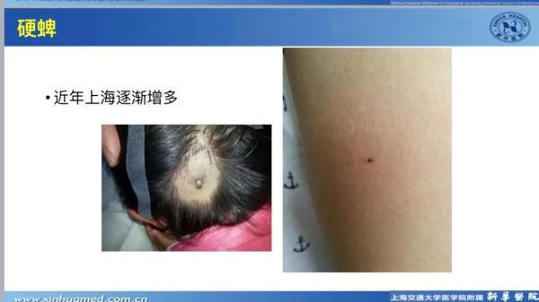 最长国庆长假即将到来，准备带娃去野外撒欢吗？这份防虫攻略请收好