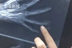 网红游戏又出意外！玩“密室逃脱”女子手指被踩断图片