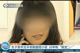 南京：女子患罕见半侧颜面短小症，20年盼容貌“蜕变”视频封面