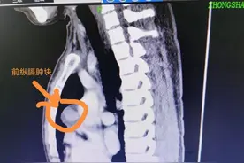 广东一男子突然睁不开眼，一查问题居然出在胸口图片