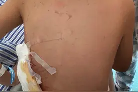 母女俩小区散步遭烈性犬咬伤 8岁女孩昏迷住院23天，家属欲追究狗主人刑责图片