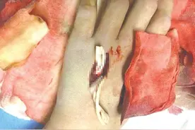 长春13岁男孩攒钱网购异宠被咬进ICU，宠物蛇竟是毒蛇竹叶青图片