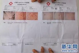 幼儿园多名孩子身上出现针眼，警方介入图片