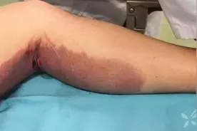 年轻小伙吃下 5 片安眠药，一觉醒来身上出现大片瘀斑图片