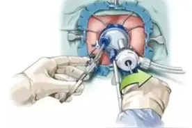 治病不保肛，保肛不治病？绵阳四〇四医院给你“双全法”图片