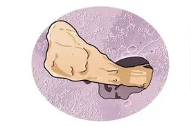 天天掏耳朵很舒服？别乱来！医生劝你手下留情图片