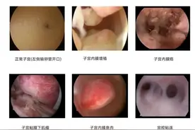 你的情况需要做宫腔镜检查吗？图片