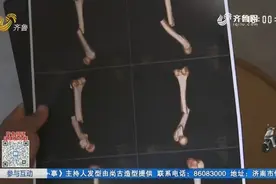没警示标志，男子晚上回家一脚踩进沟，右腿骨折卧床俩月没法走视频封面