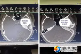 愿为您的耳朵带来“温度”——邵阳市中心医院耳鼻喉科人工听小骨植入听力重建术图片