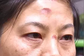 贵阳一女子被这东西绊倒，摔得鼻青脸肿！女子委屈又愤怒：到底谁来管？图片