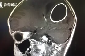 蛀牙一年以为上火没重视 8岁孩子脑内长出大脓肿差点丧命图片