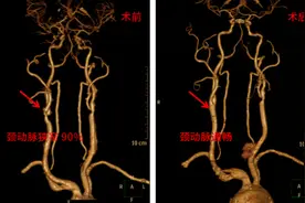 30年老烟枪颈动脉重度狭窄 小切口解决大“堵塞”图片
