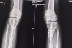 在国外做断骨增高手术感染，22岁患者恐终身残疾图片