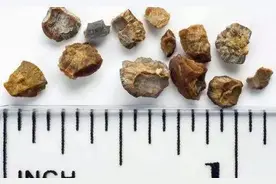 这些人容易长泌尿结石，教你两步防住它图片