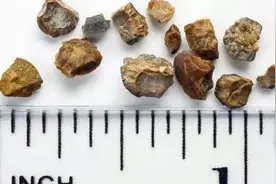 这些人容易长泌尿结石，教你两步防住它图片