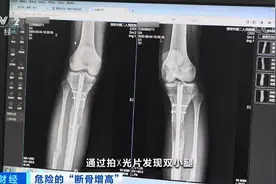 因身材自卑，他赴韩国“断骨增高”！严重感染，或终身残疾...穿透双腿的钢针，是增高器还是凶器？图片