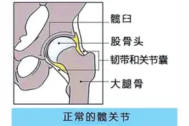 婴儿髋关节筛查不能忽视图片