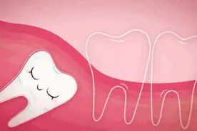 口腔科医生：6种智齿别再留着了图片
