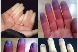 天气凉了，小心手指变色是这种疾病图片