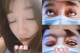 美容变“毁容”？女子做完手术悲剧了，左眼没法完全闭上图片