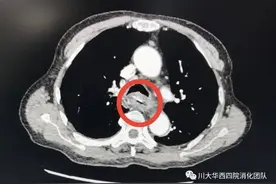 一小块鸡骨险致死 医生：小孩、老人误吞这些很危险图片