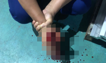恐怖警笛头破解版（男子深夜加班被切断两根手指只剩一丝皮医生摇头说）