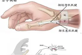 长时间劳累有了“妈妈手”，手腕疼痛无力怎么办？图片