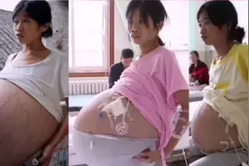 巨肚妈妈手术成功！共从她肚子里取出近80斤肿瘤和腹水图片