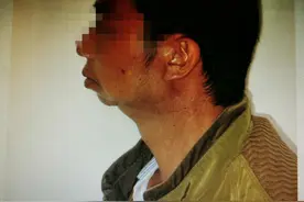 男子摔伤30多年不能张口 手术后“重获新生”医生：下巴受伤别大意图片