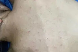 25岁女子为减肥打蛋白液，结果身上多处流血结节，“动了117刀”图片