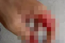 吉大男子遇上“电锯吃手”事件！但只有这个医院能接断指……图片