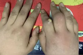 14岁就尿酸高？了解这4大危险因素，远离痛风图片