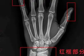 怎样判断孩子骨龄线已经闭合？