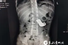 这种玩具很危险！贵州5岁男孩吞下123颗磁力珠被紧急送医图片